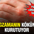 Hassas ciltlerin yeni favorisi: Egzamanın kökünü kurutuyor