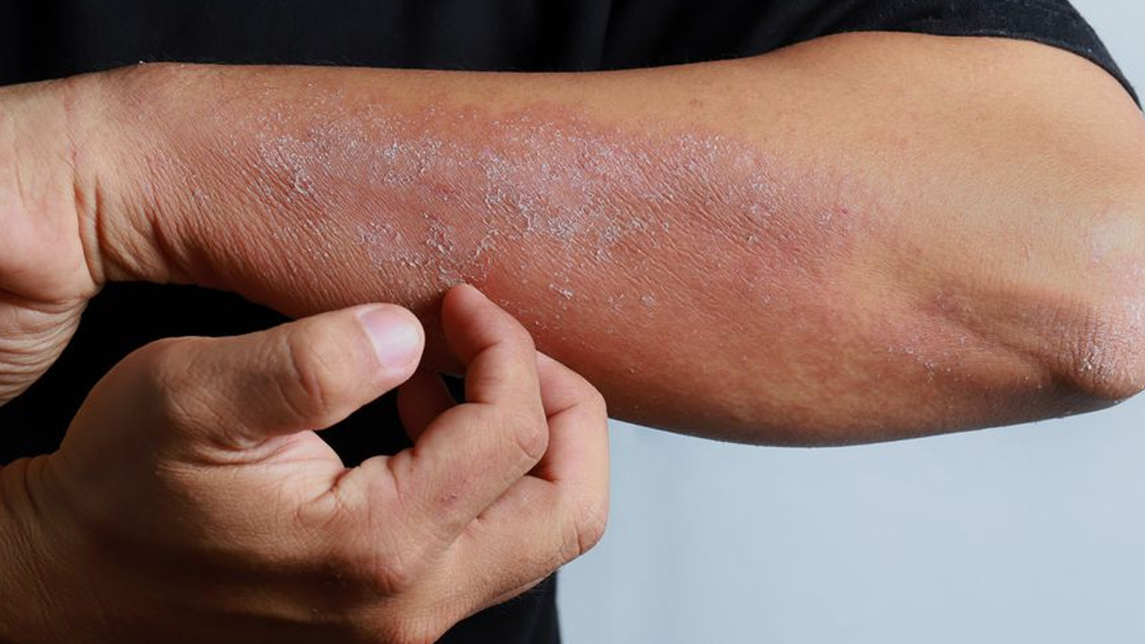 Soğuk ısırığı değil, sıcak su tehlikesi: Kış egzeması vakalarında kritik artış