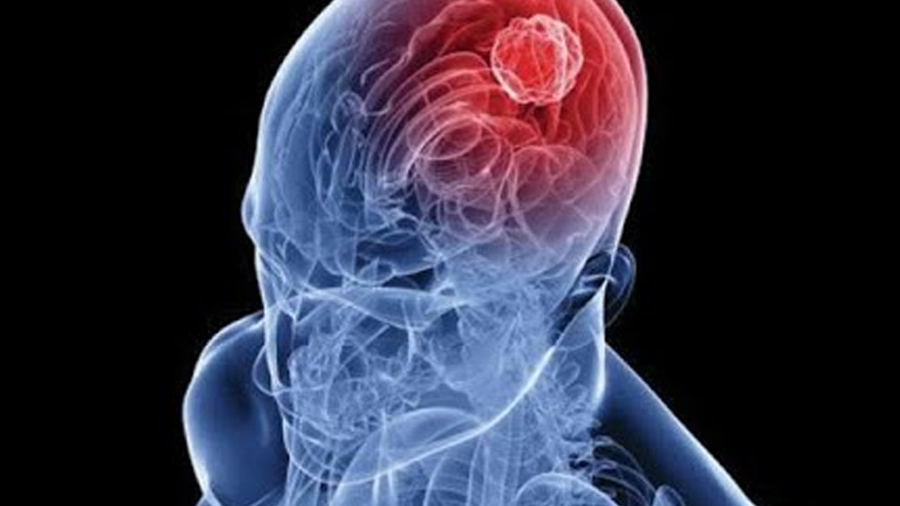 Burun spreyiyle beyin tümörüne doğrudan müdahale: Tıp dünyasında devrim