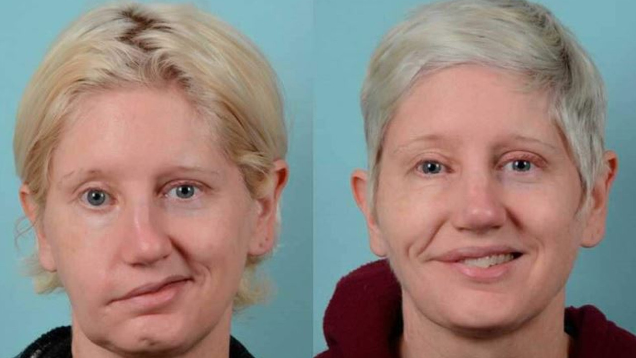 Yüz felcinde ‘altın saat’ uyarısı... Kalıcı hasar bırakmamak için kritik tüyolar