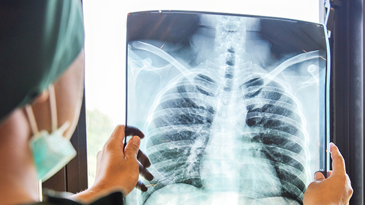 Zatürre tedavisinde 4 saat kuralı ortaya çıktı