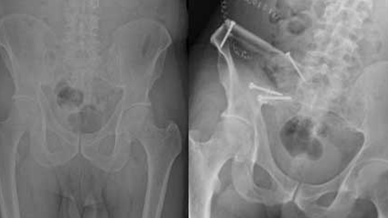 Prostat kanserinin ileri evrelerindeki kemik tehlikesiyle uzman önerileri