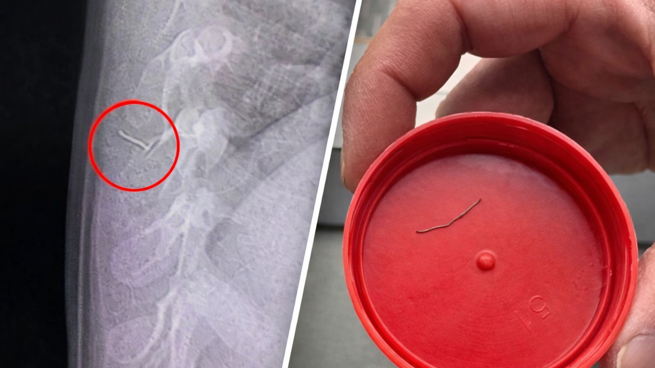 1 yaşındaki bebeğin sırtından 2 santimlik tel çıktı