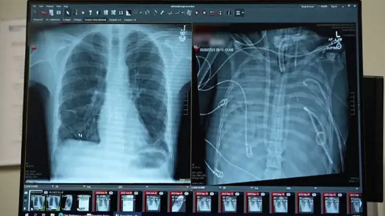 Organ nakli tarihe mi karışıyor?