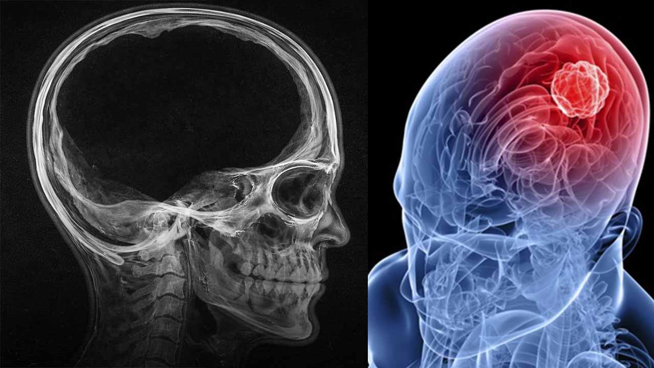 Beyin kütlesinin %90'ı eksik olan bir adam keşfedildi: Buna rağmen normal bir hayat yaşıyor