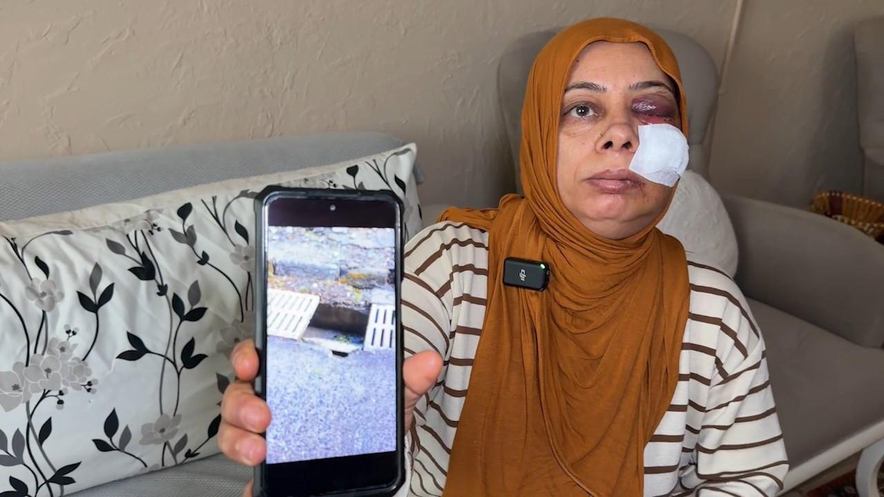 Hatay'da kırık rögar kapağına düştü ölümden döndü: Şükriye'nin yüzüne tam 14 dikiş atıldı