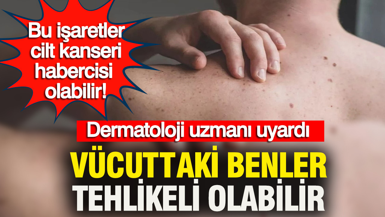 Vücudunuzdaki benler değişiyor mu: Dermatolog uyardı: Bu işaretler cilt kanseri habercisi olabilir