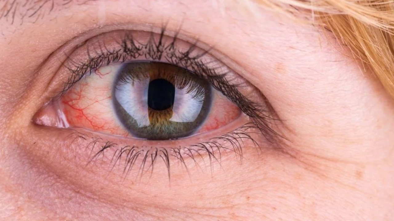 Sağlık Bakanlığı'ndan glokom açıklaması