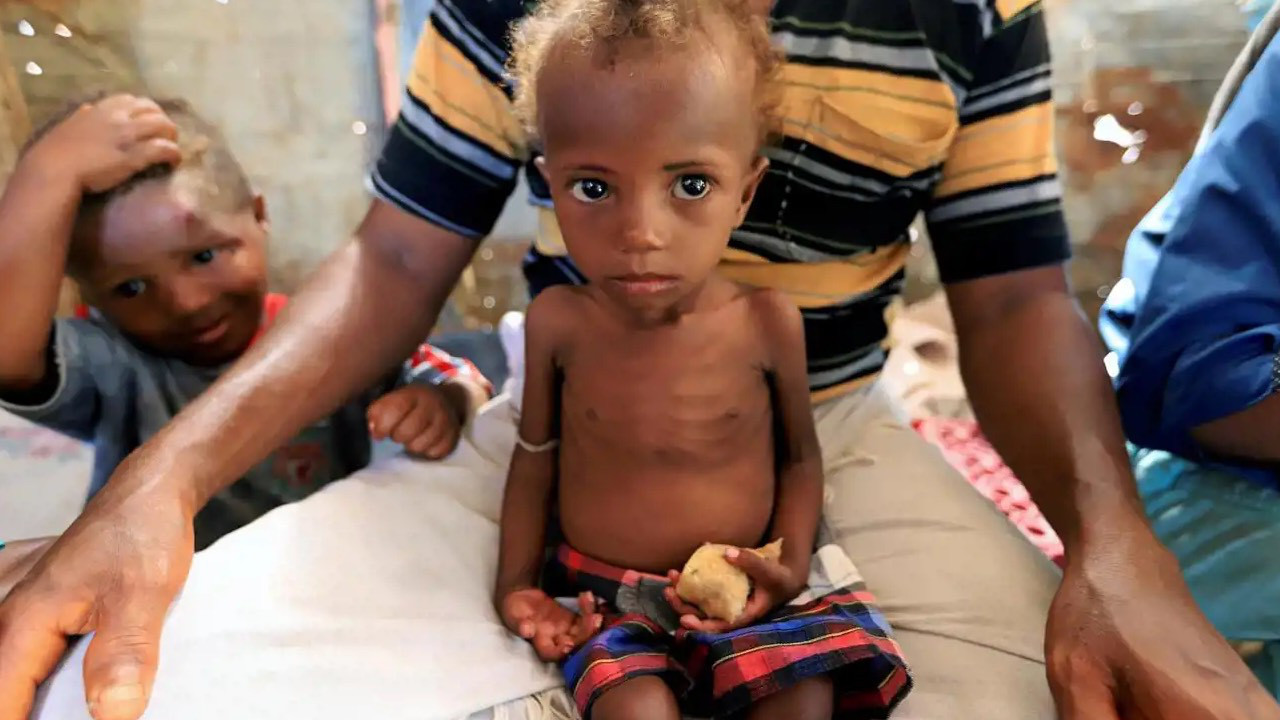 Yemen'de kızamık vakalarında patlama: 36 çocuk öldü