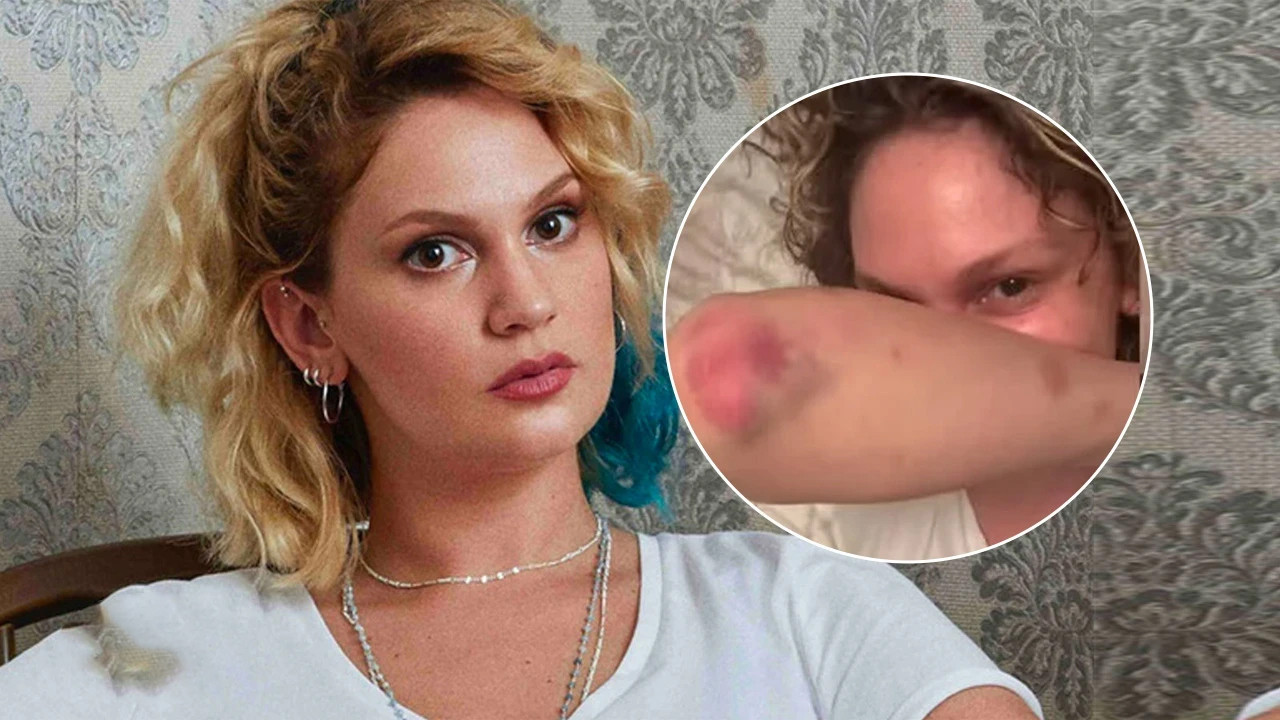 Farah Zeynep Abdullah’ın vücudundaki morluklar dikkat çekti