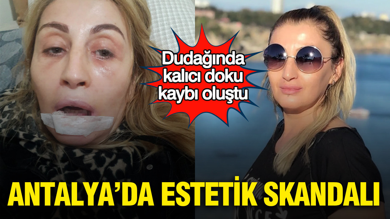 Antalya'da estetik skandalı: Dudağında kalıcı doku kaybı oluştu