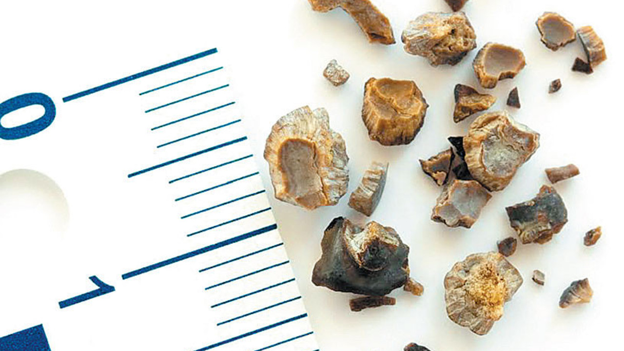 Böbrek taşı tedavisinde en son teknoloji: Endoskopik lazer cerrahisi