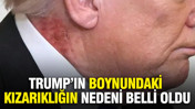 Trump&rsquo;ın boynundaki kızarıklığın nedeni belli oldu