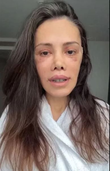 Survivor’ın eski yarışmacısı Didem Ceran’dan yürek burkan haber: Yüz nakli olmuştu - Resim: 7