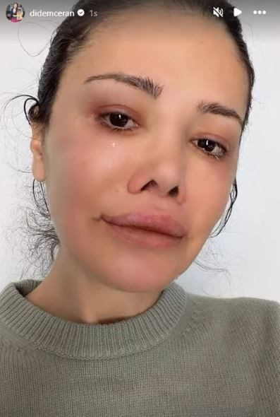 Survivor’ın eski yarışmacısı Didem Ceran’dan yürek burkan haber: Yüz nakli olmuştu - Resim: 4