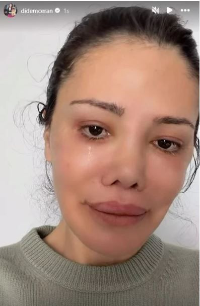 Survivor’ın eski yarışmacısı Didem Ceran’dan yürek burkan haber: Yüz nakli olmuştu - Resim: 2
