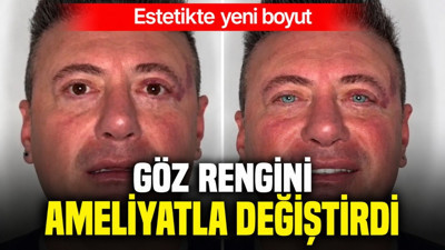 Estetikte yeni boyut: Göz rengini ameliyatla değiştirdi