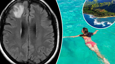 Beyninde gizlenen parazit kabusu oldu: Tatil dönüşü acı gerçekle karşılaştı