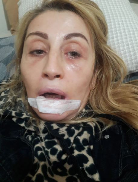 Antalya’da estetik skandalı: Dudağında kalıcı doku kaybı oluştu - Resim : 3