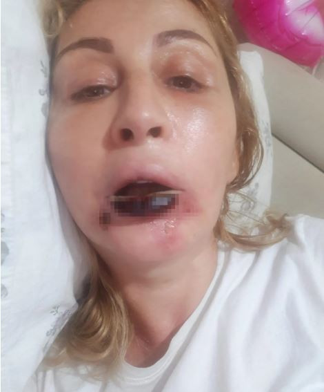 Antalya’da estetik skandalı: Dudağında kalıcı doku kaybı oluştu - Resim : 4