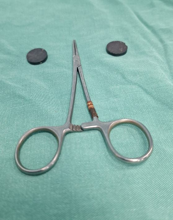 Tuvalet yapamayan çocuğun bağırsağından iki mıknatıs çıktı - Resim : 1