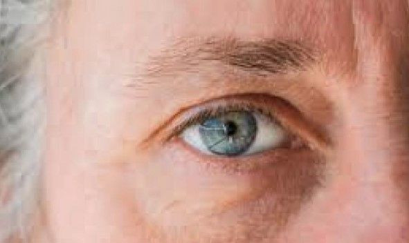 Milyonlar kişi farkında değil: Glokom sessizce görme kaybına yol açıyor - Resim: 5