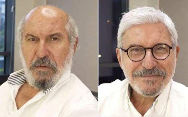 Hüseyin Soysalan'ın protez saçlı yeni imajı olay oldu - Resim : 2
