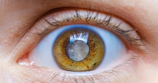 Milyonlar kişi farkında değil: Glokom sessizce görme kaybına yol açıyor - Resim: 7