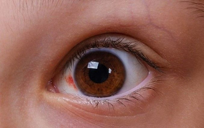 Milyonlar kişi farkında değil: Glokom sessizce görme kaybına yol açıyor - Resim: 1