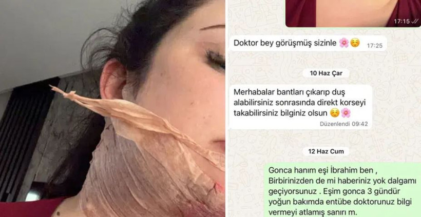 Estetik yaptırdı ölümden döndü: Hocam patlayacak gibi - Resim : 1