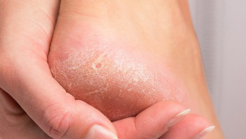 Nasır acı veriyor mu? İşte evde uygulayabileceğiniz mucizevi çözümler - Resim : 1