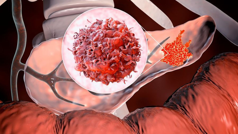 Pankreas kanserinde yeni dönem: FDA ilk RAS hedefli tedaviyi onayladı - Resim : 2
