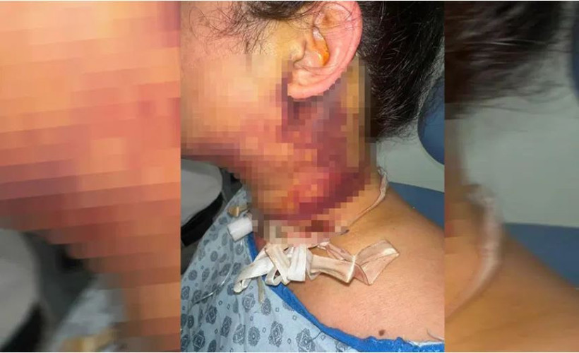 Estetik yaptırdı ölümden döndü: Hocam patlayacak gibi - Resim : 2