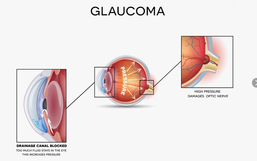 Bu hastalık sessizce ilerliyor, teşhis gecikirse kör ediyor: Uzmanlar uyardı - Resim: 12