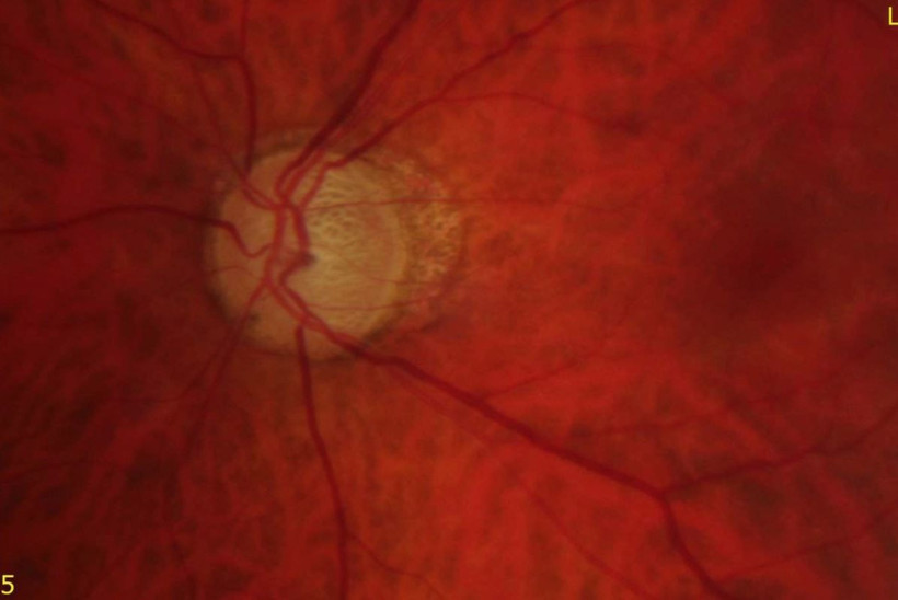 Bu hastalık sessizce ilerliyor, teşhis gecikirse kör ediyor: Uzmanlar uyardı - Resim: 13