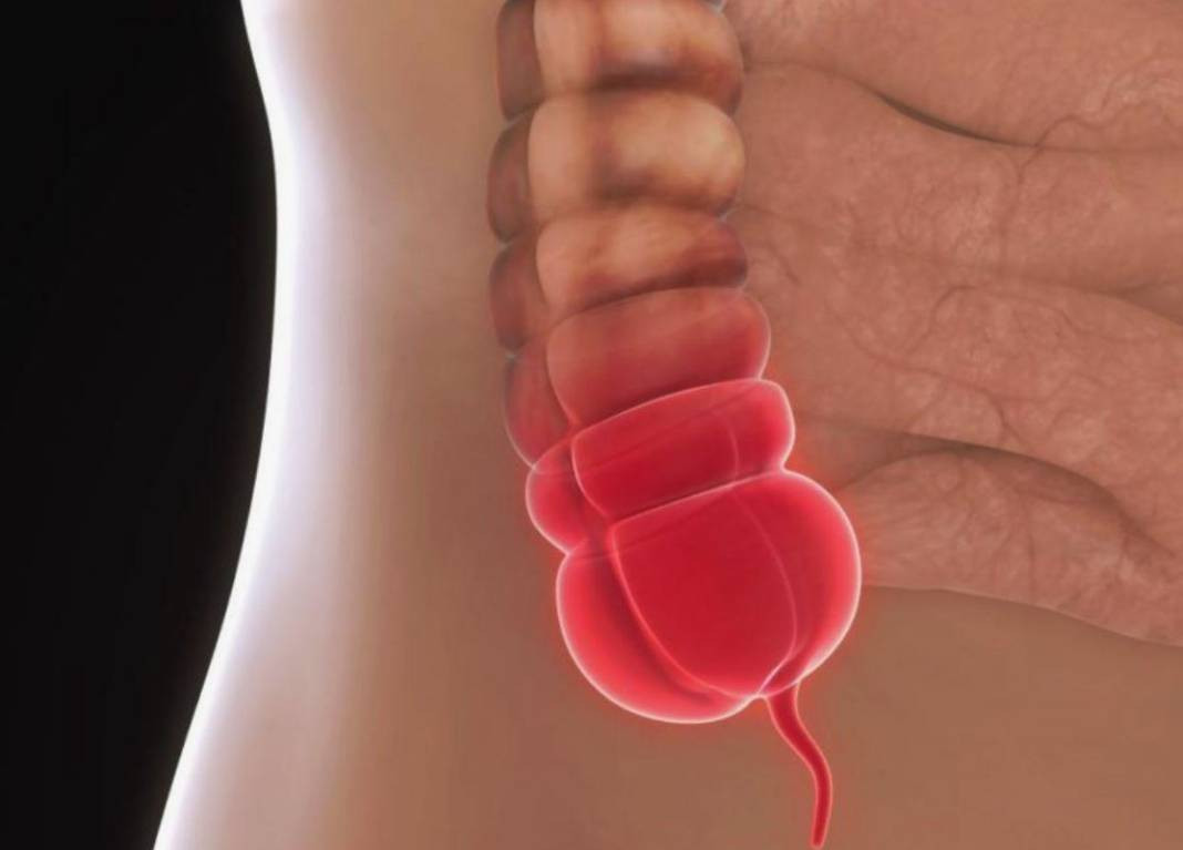 Apandisit nedir? Apandisit gereksiz bir organ mı?